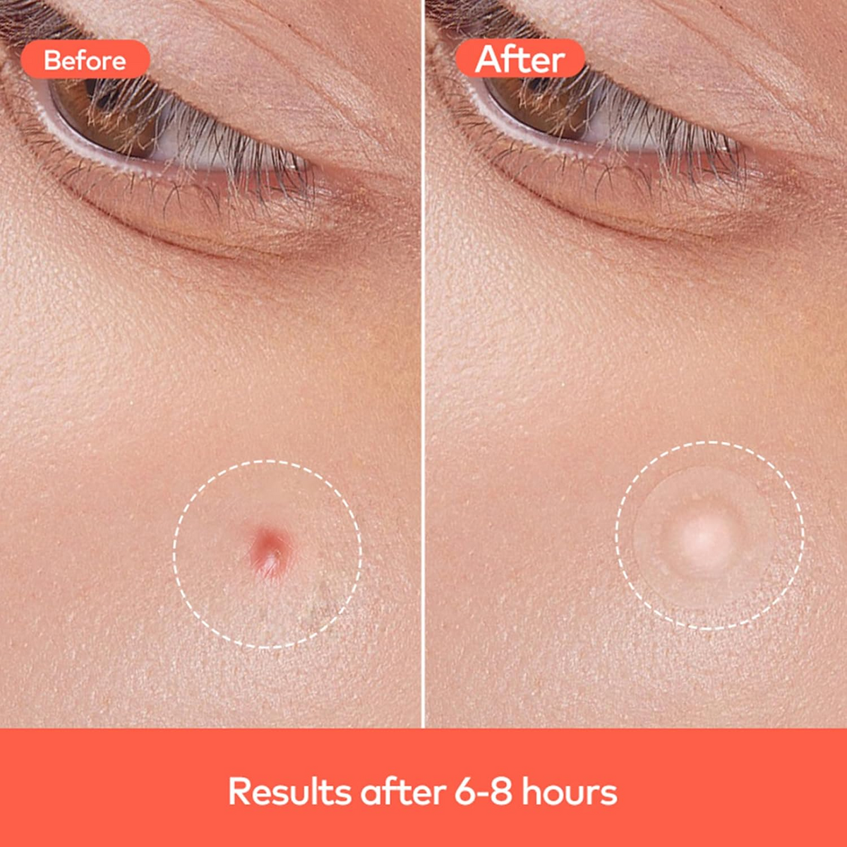 Pimple Patches for Face (3 Sheet Set)